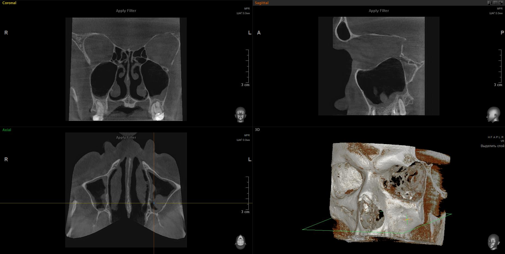 Компьютерная томография придаточных пазух носа