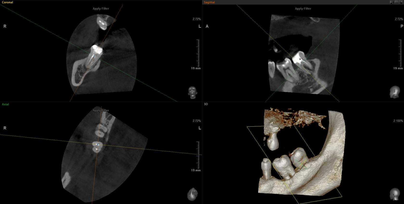 Компьютерная томография сегмента 5х5 (2-3 зуба)