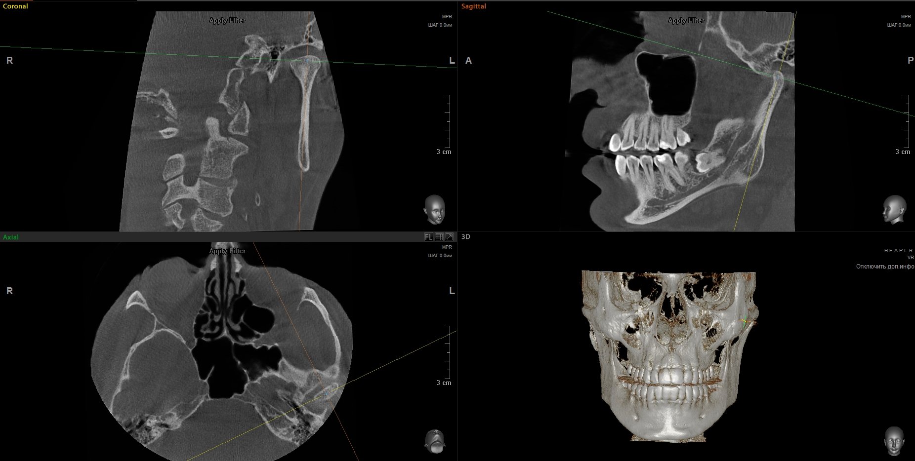 Компьютерная томография челюстей и ВНЧС